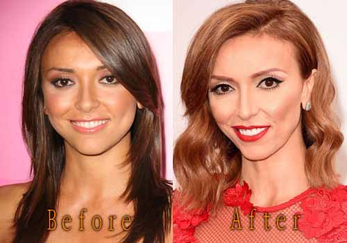 Giuliana Rancic Plastic Surgery, Before and After Pictures