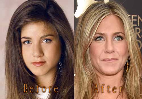 Jennifer Aniston Plastic Surgery Boob, Nose Job Before and After Pictures