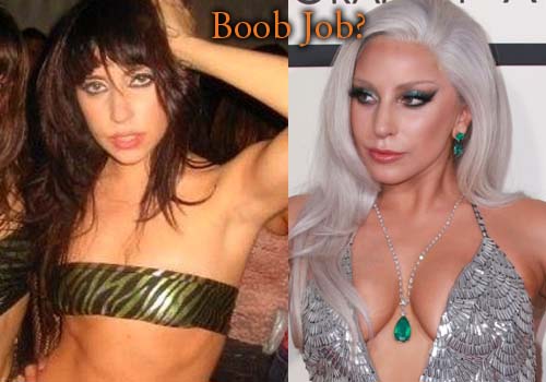 Lady Gaga Breast Surgery 16
