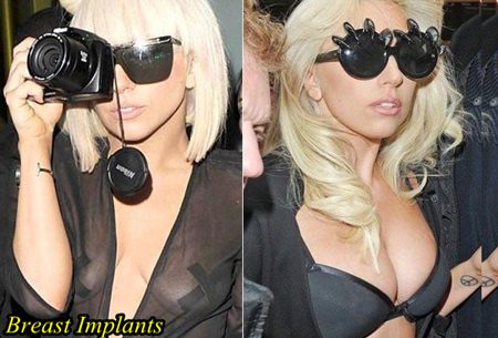 Lady Gaga Breast Surgery 56