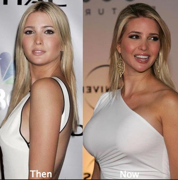 ivanka-trump-breast-implants-before-and-after