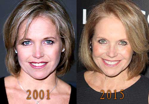 Katie Couric Facelift