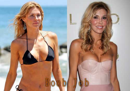 Brandi Glanville Plastic Surgery Before and After.