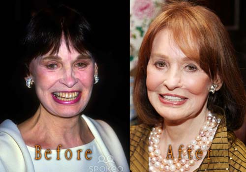 Gloria Vanderbilt Plastic Surgery