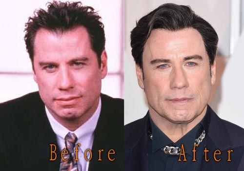 John Travolta Plastic Surgery