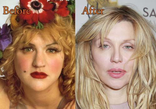 Courtney Love Plastic Surgery, Before and After Facelift Pictures