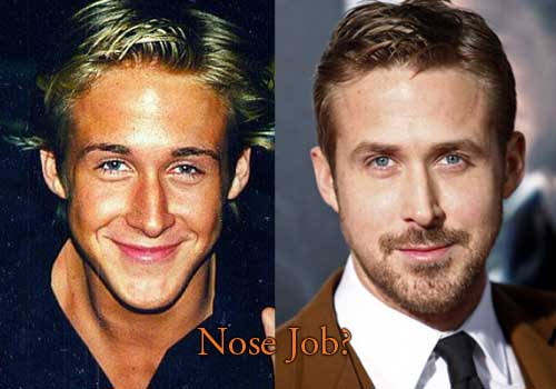 Gosling Nose Job