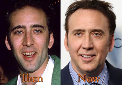 Nicolas Cage Botox