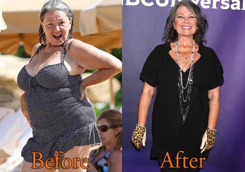Roseanne Barr Weight Loss, Tummy Tuck