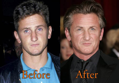 Sean Penn Plastic Surgery