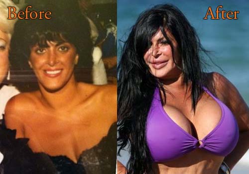 Big Ang Plastic Surgery Picture