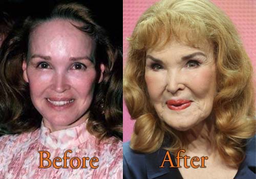 Kathryn Crosby Plastic Surgery Picture