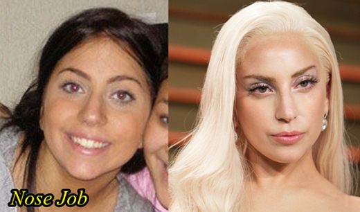 Lady-Gaga-Plastic-Surgery-Nose-Job